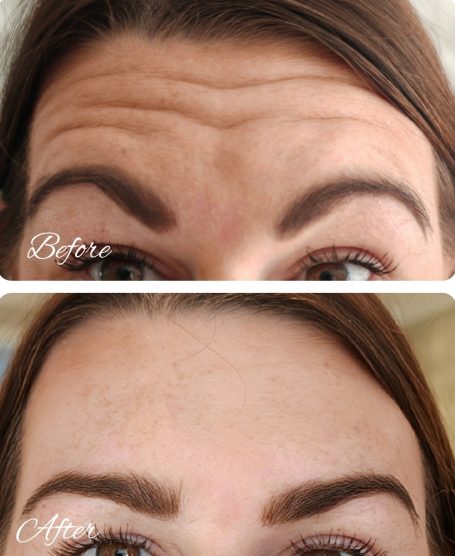 Botox