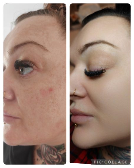 Microneedling with exosomes
